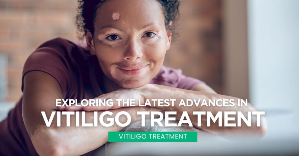 Vitiligo Treatment