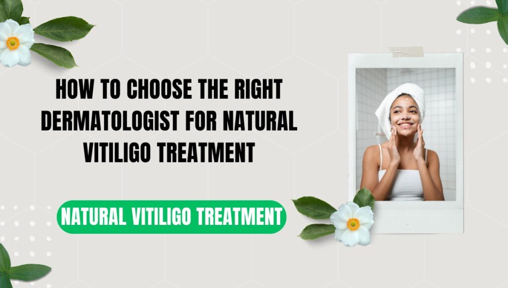 natural vitiligo treatment