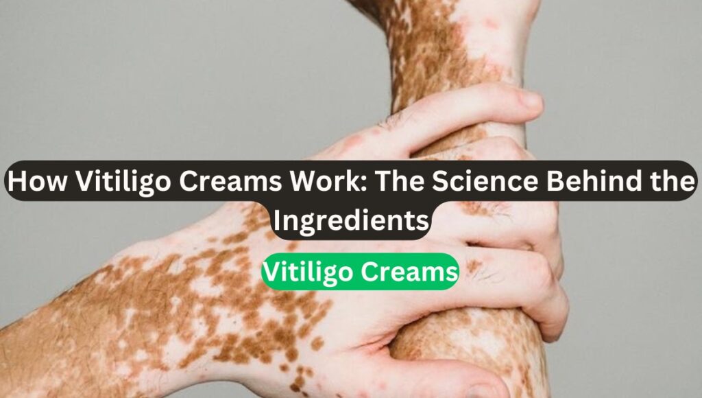 how vitiligo cream works