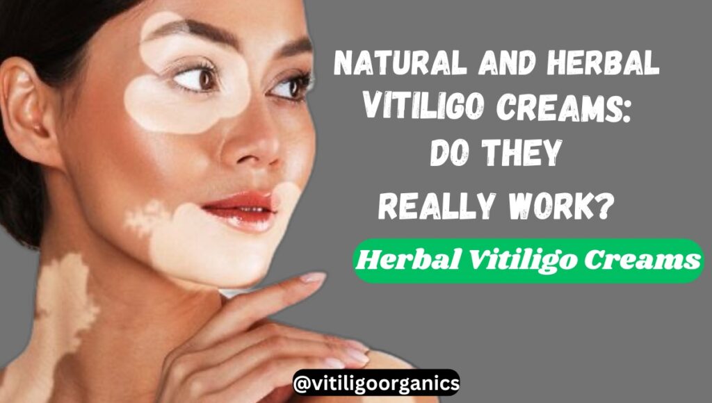 vitiligo creams