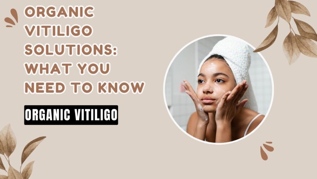 organic vitiligo treatments